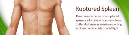 What causes a ruptured spleen? Ruptured Spleen Causes Signs Symptoms Tests Treatment Prevention