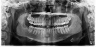 Specifically, it is an aggressive malignant neoplasm that arises from primitive transformed cells of mesenchymal origin (and thus a sarcoma). Giant Cell Granuloma Mandible Radiology Case Radiopaedia Org