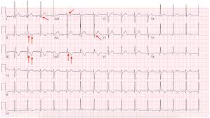 It was undetermined if these patients had myocarditis. Cureus Atypical Manifestation Of Covid 19 Induced Myocarditis