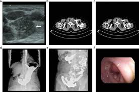 Patient preparation and position for the ultrasound examination 4. Cervical Lymph Node Enlargement As The Initial Manifestation Of Rectal Cancer Bmc Gastroenterology Full Text