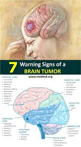 7 Warning Signs Of A Brain Tumor Brain Tumor Brain Tumor Awareness Tumor