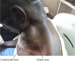 Lymphatic vessels of the head and neck, with the supraclavicular lymph nodes described as deep cervical lymph nodes, visible at the bottom. Metastatic Cervical And Supraclavicular Lymphadenopathy From Prostate Mimicking Lymphoma A Case Series