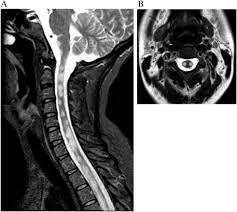 Your doctor may then recommend: Concurrent Guillain Barre Syndrome Transverse Myelitis And Encephalitis Post Zika A Case Report And Review Of The Pathogenic Role Of Multiple Arboviral Immunity Sciencedirect