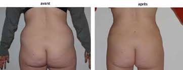 Comment perdre les poignées d'amour grâce à l'alimentation ? Liposuccion Des Poignees D Amour