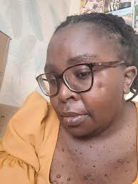 Had full spine MRI and brain MRI, and the tumors are growing, the S1  shwannoma is now 15mm, it was 13 mm about 2-3 months ago, I also have new  ones in