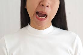 Tardive dyskinesia adalah gangguan gerakan yang. 10 Penyebab Bell S Palsy Yang Perlu Diwaspadai