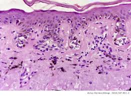 Pronounced pigmention of the tips of elongated rete. Is It Solar Lentigo Or Lentigo Maligna It Is Not A Nevus Actas Dermo Sifiliograficas
