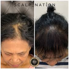 Scalp Micropigmentation for Women Hair Loss