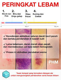 Bagi ibu ibu jangan sampai anak kalian seperti ini , jangan lupa subcribe and share biar ibu2 di yakin pasangan kamu masih perawan ? Public Health Malaysia Lebam Berlaku Apabila Ada Kecederaan Yang Menyebabkan Saluran Darah Halus Di Bawah Kulit Pecah Dan Mengakibatkan Pendarahan Darah Dibawah Kulit Inilah Yang Akibatkan Warna Merah Pada Permukaan Kulit