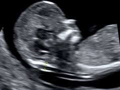 Die ärtin hat dazu gar nicht gesagt. Zentrum Fur Pranataldiagnostik Und Humangenetik Kudamm 199