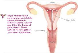 Pin On Iud S