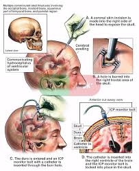 Brain Surgery Ventriculostomy And Placement Of Intracranial Intra Cranial Pressure Monitoring Intracranial Pressure Brain Surgery Brain Surgery Recovery