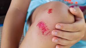 8 Year Old Dies From Flesh Eating Bacteria After Falling Off His Bike