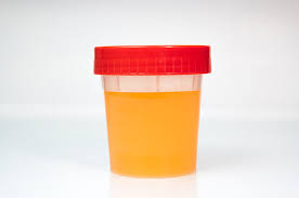 Urine berwarna coklat juga dapat menjadi tanda bahwa anda mengalami dehidrasi sehingga perlu. Urine Berwarna Kuning Saat Puasa Tanda Kurang Minum