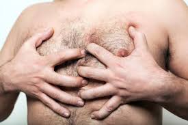 Left untreated, male breast enlargement can cause a complex surrounding body image. Gynecomastia Surgery Treatment Causes And Symptoms