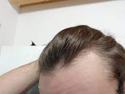 Sharing information and talking health! Receding Hairline At 19 Years Old Hairlosstalk Forums