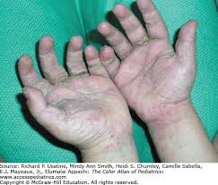 Image result for scabies human children
