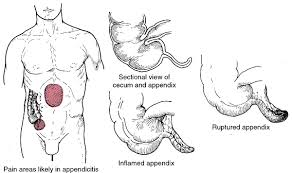 Appendicitis Definition Of Appendicitis By Medical Dictionary | meaning, pronunciation, translations and examples. appendicitis by medical dictionary