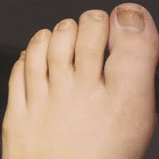 In 1977 marley found an injury on his big toe which he thought was a result of a soccer game, marley had tests and a diagnosis of the injury to find that he had malignant melanoma, a type of skin cancer, under his toenail. Clinical Image Of The Painful Left Great Toe With A Slowly Enlarging Download Scientific Diagram