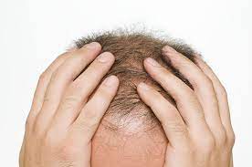 Top 5 Baldness Myths What S True About Hair Loss Hair Transplant Hair Loss Men Hair Transplant Surgery Help Hair Loss