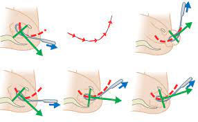 Dr pieter mourik demonstrates how to use kiellands forceps on a mannequin. Traction With Kielland S Forceps Elearning
