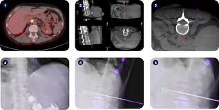 Percutaneous biopsy synonyms, percutaneous biopsy pronunciation, percutaneous biopsy translation, english dictionary definition of percutaneous biopsy. Micromate Case Report Robot Guided Para Aortic Biopsy Interventional Systems