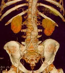 Da quali sintomi si riconosce? Aortenaneurysma Wikipedia
