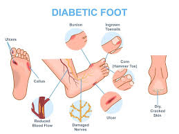Image result for diabetic toes