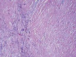 Hiroshi hirano, department of pathology, toneyama Desmoplastic Malignant Mesothelioma Thoracic Pathology A Volume In The High Yield Pathology Series Expert Consult Online And Print 1st Edition