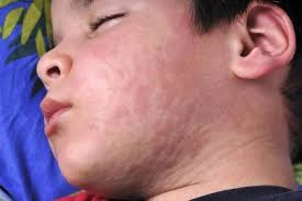 Image result for vyrážka u dětí