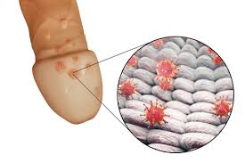 Image result for genital warts