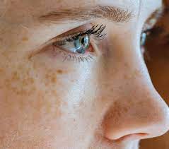 Best Medical Treatment for Melasma in Dubai (Brown Spots)