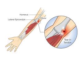 Image result for Epicondyle Injection