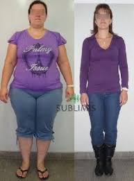 Fotos De Antes Y Despues De Una Cirugia De Manga Gastrica Womens Shorts Gastric Sleeve Women