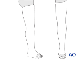 Maybe you would like to learn more about one of these? Nonoperative Casting For Wedge Fracture Intact Wedge