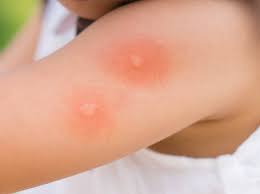 Image result for mosquito bite