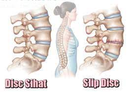 Penggunaan peranti mudah alih telah menyebabkan masalah leher yang. Lihat Pesakit Slip Disc Ini Kembali Sembuh Tanpa Pembedahan I Am Zuraida