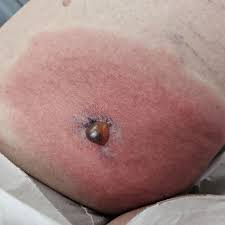 Image result for spinne biss haut reaktion