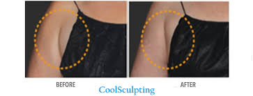 So, if you are trying to get rid of the flabby underarms daily cardiovascular exercises can be of it works out the muscles of your back, shoulder, chest and arms. Bye Bye Bra Bulge How To Get Rid Of Armpit Fat With 6 Proven Methods Skinney Medspa