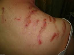 Image result for Neurotic Excoriation