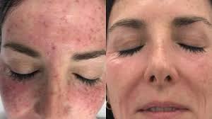 Here are ways to get rid of freckles with remedies and easy recipes at home. Freckle Removal London Pulse Light Clinic London