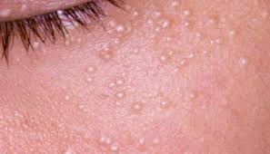 I don't know if it's keratosis pilaris or milia or clogged pores :( i just really want to get rid of them. What Are Milia The Elegant Luxe Life