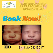 3D Ultrasound