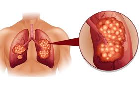 As the cancer develops, these symptoms may become more severe or intense. 8 Lung Cancer Symptoms You Should Know About Even If You Re Not A Smoker Satenaw Ethiopian News Breaking Newssatenaw Ethiopian News Breaking News