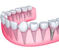 He has been practicing at franklin dental associates since he finished dental school. Dental Implants Franklin Oh Missing Tooth Solution