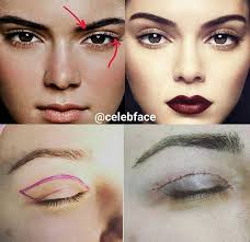 Young beautiful woman, with tired sad eye appearance, underwent canthoplasty and internal droopy upper eyelid ptosis surgery, to create more rested, almond shaped eyes. Kendall Jenner Blepharoplasty Eyelid Surgery Kendall Jenner Plastic Surgery Kendall Jenner Eyes Kendall Jenner