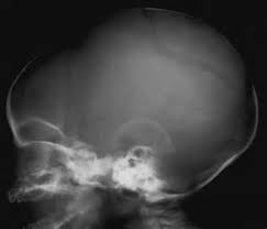 Dampak atau pukulan pada kepala yang. Tengkorak Fraktur Penyakit Lain X Ray Virtual Film X Vif