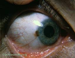 Image result for nevus sclerae