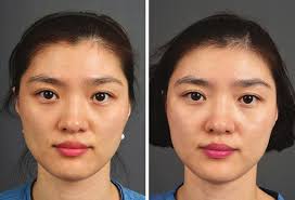 Plastic and Reconstructive Surgery®