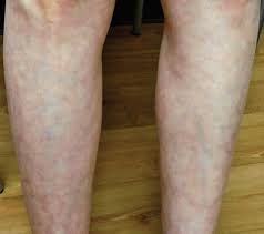 It is chronic and hence is hardly reversible. What Is The Cause Of This Patient S Leg Discoloration The Dermatologist